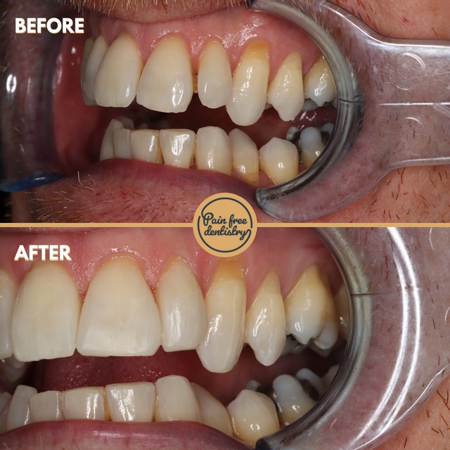 Composite bonding before and after, front teeth result