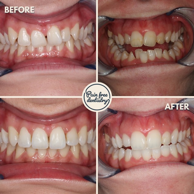 Clear aligner teeth straightening before and after result
