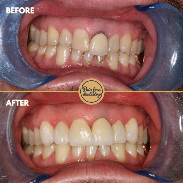Porcelain veneers — before and after smile transformation, Pain-Free Dentistry Chorley