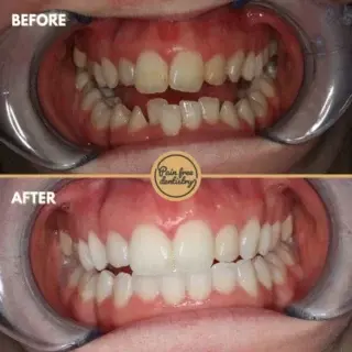 Straight Teeth